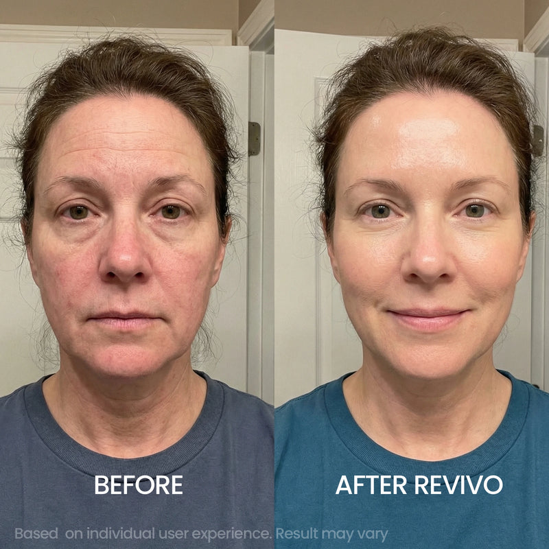 "Friends Asked If I Got Botox. I Didn't."